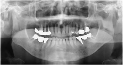 Case report: Remission of chronic low back pain and oral dysesthesia comorbid with attention deficit/hyperactivity disorder by treatment with atomoxetine and pramipexole